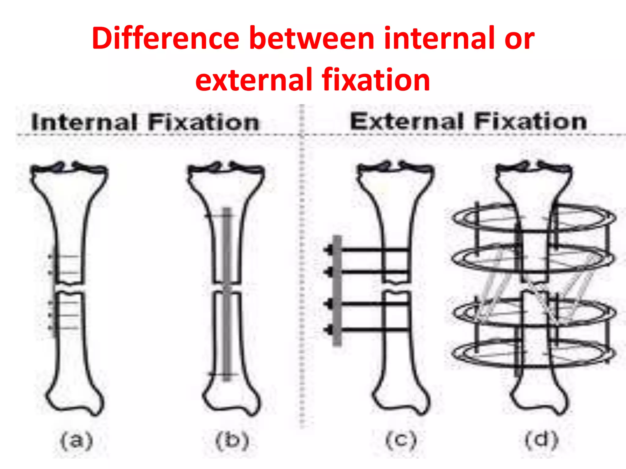 Difference between internal or
external fixation
 