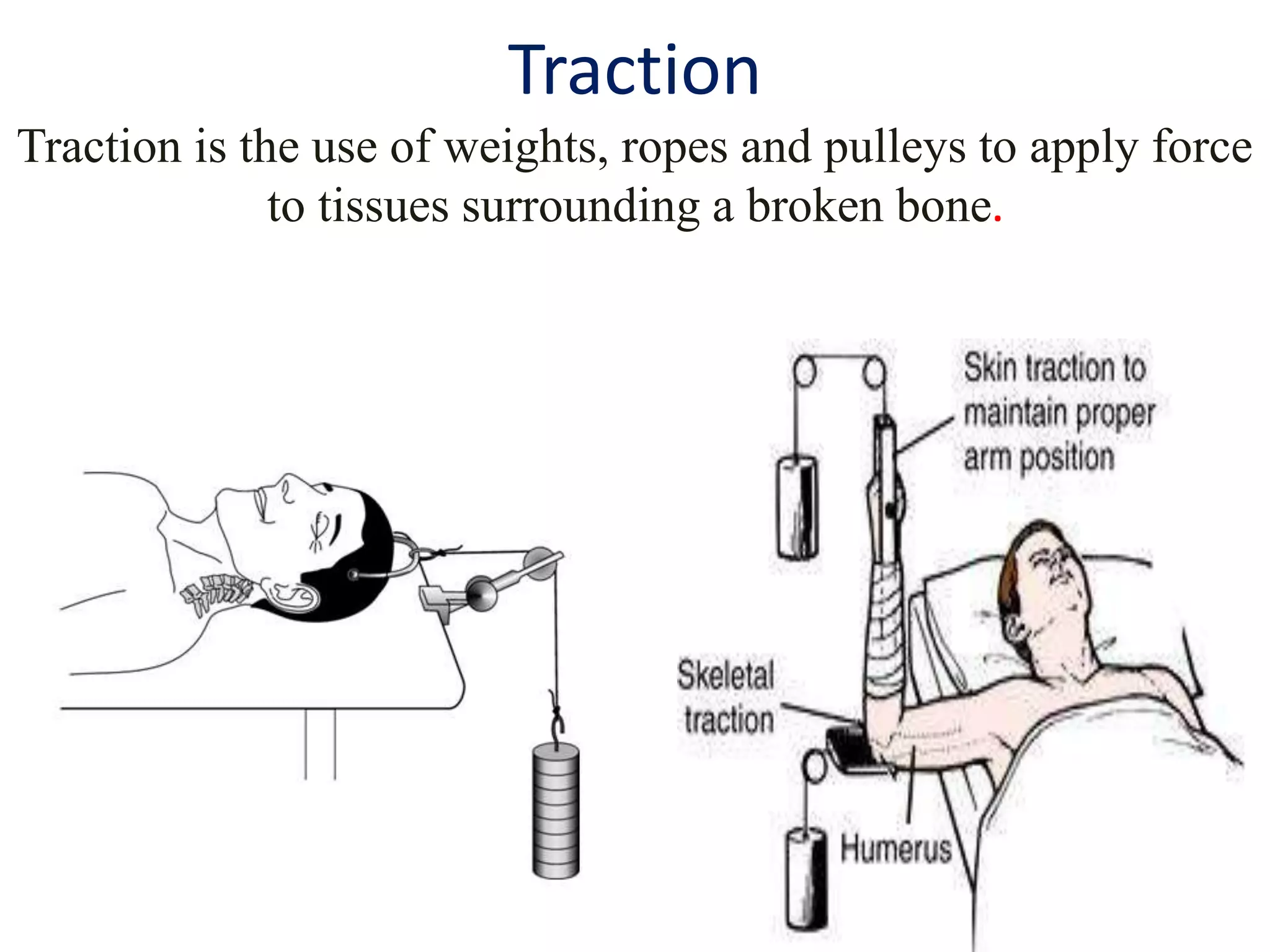 Traction
Traction is the use of weights, ropes and pulleys to apply force
to tissues surrounding a broken bone.
 