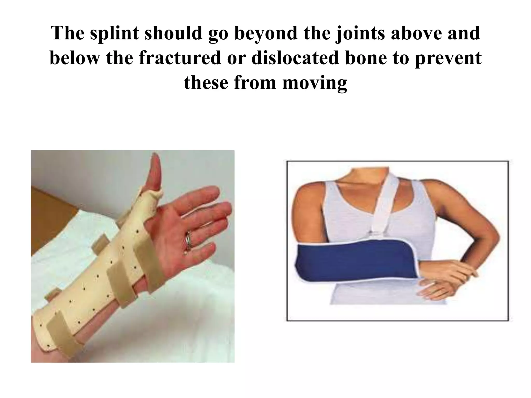 The splint should go beyond the joints above and
below the fractured or dislocated bone to prevent
these from moving
 