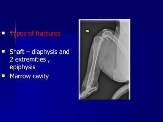    Types of fractures

   Shaft – diaphysis and
    2 extremities ,
    epiphysis
   Marrow cavity
 