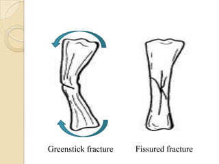 Greenstick fracture   Fissured fracture
 