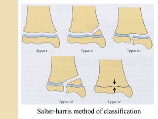 Salter-harris method of classification
 