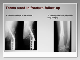 1.Position - changed or unchanged
Terms used in fracture follow-up
.2. Healing -central or peripheral
bony bridging
 