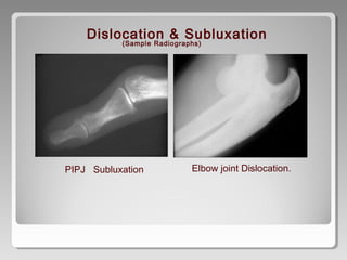PIPJ Subluxation Elbow joint Dislocation.
Dislocation & Subluxation
(Sample Radiographs)
 