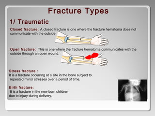 Closed fracture: A closed fracture is one where the fracture hematoma does not
communicate with the outside
Open fracture:  This is one where the fracture hematoma communicates with the
outside through an open wound.
1/ Traumatic
Fracture Types
Stress fracture : 
It is a fracture occurring at a site in the bone subject to
repeated minor stresses over a period of time.
Birth fracture: 
It is a fracture in the new born children
due to injury during delivery.
 