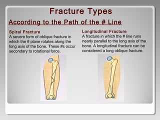 Spiral Fracture
A severe form of oblique fracture in
which the # plane rotates along the
long axis of the bone. These #s occur
secondary to rotational force.
Longitudinal Fracture
A fracture in which the # line runs
nearly parallel to the long axis of the
bone. A longitudinal fracture can be
considered a long oblique fracture.
According to the Path of the # Line
Fracture Types
 
