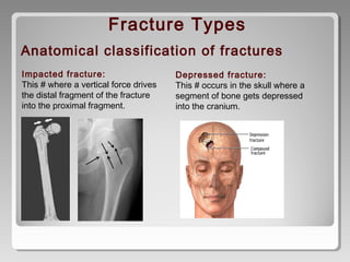 Anatomical classification of fractures
Impacted fracture:
This # where a vertical force drives
the distal fragment of the fracture
into the proximal fragment.
Fracture Types
Depressed fracture:
This # occurs in the skull where a
segment of bone gets depressed
into the cranium.
 