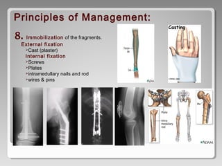 Fracture | PPT
