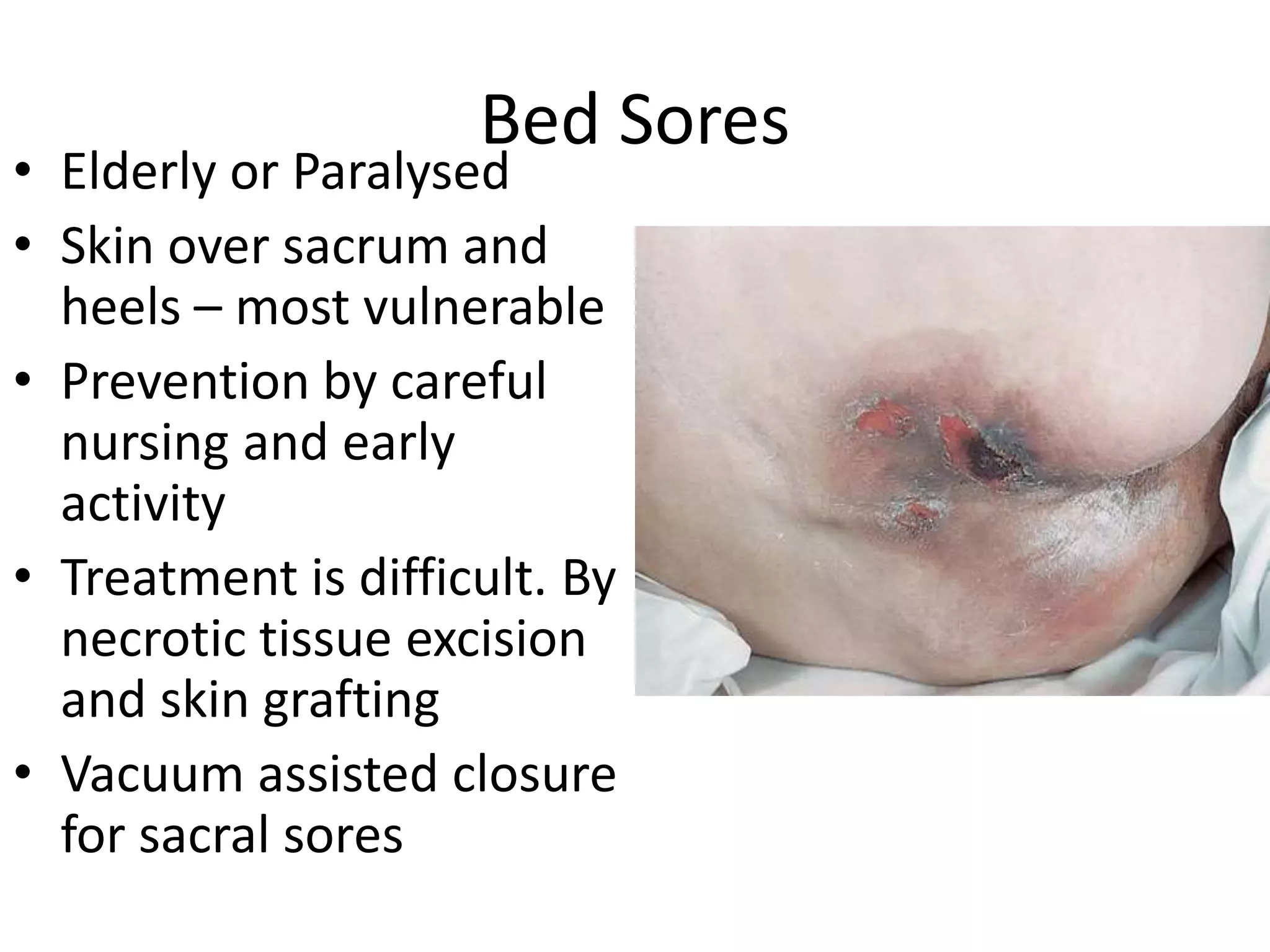 Bed Sores
• Elderly or Paralysed
• Skin over sacrum and
heels – most vulnerable
• Prevention by careful
nursing and early
activity
• Treatment is difficult. By
necrotic tissue excision
and skin grafting
• Vacuum assisted closure
for sacral sores
 