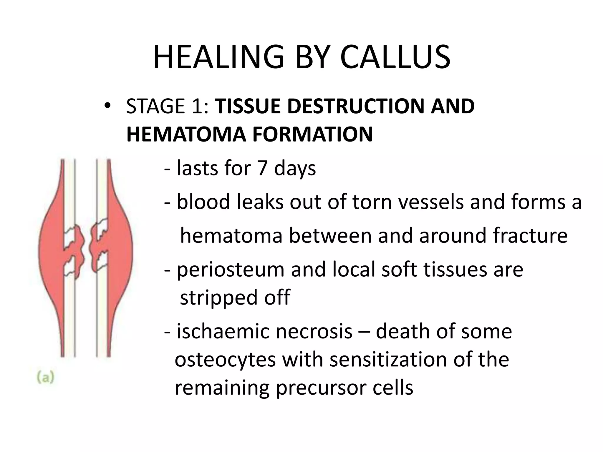 HEALING BY CALLUS
• STAGE 1: TISSUE DESTRUCTION AND
HEMATOMA FORMATION
- lasts for 7 days
- blood leaks out of torn vessels and forms a
hematoma between and around fracture
- periosteum and local soft tissues are
stripped off
- ischaemic necrosis – death of some
osteocytes with sensitization of the
remaining precursor cells
 