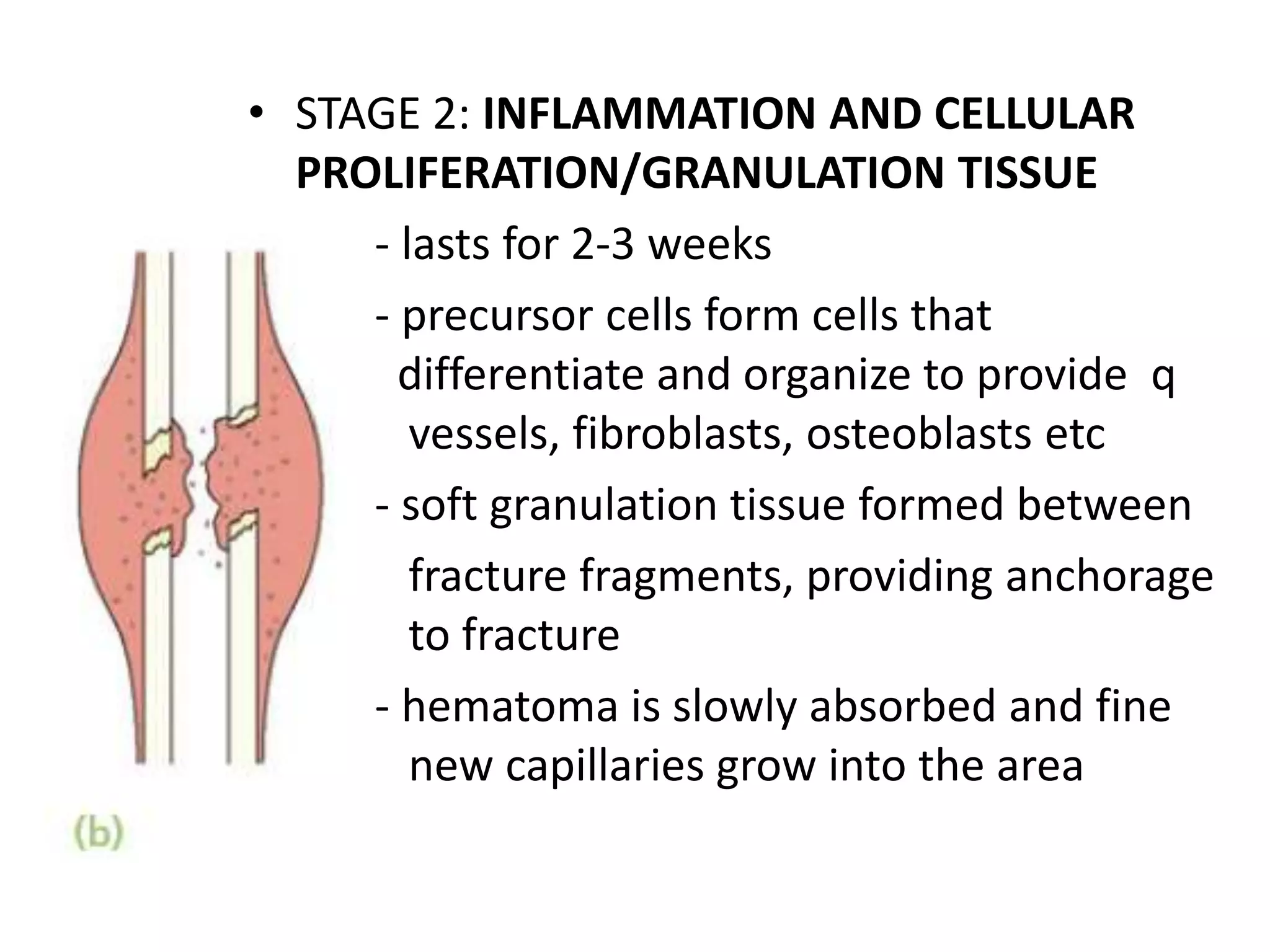 • STAGE 2: INFLAMMATION AND CELLULAR
PROLIFERATION/GRANULATION TISSUE
- lasts for 2-3 weeks
- precursor cells form cells that
differentiate and organize to provide q
vessels, fibroblasts, osteoblasts etc
- soft granulation tissue formed between
fracture fragments, providing anchorage
to fracture
- hematoma is slowly absorbed and fine
new capillaries grow into the area
 