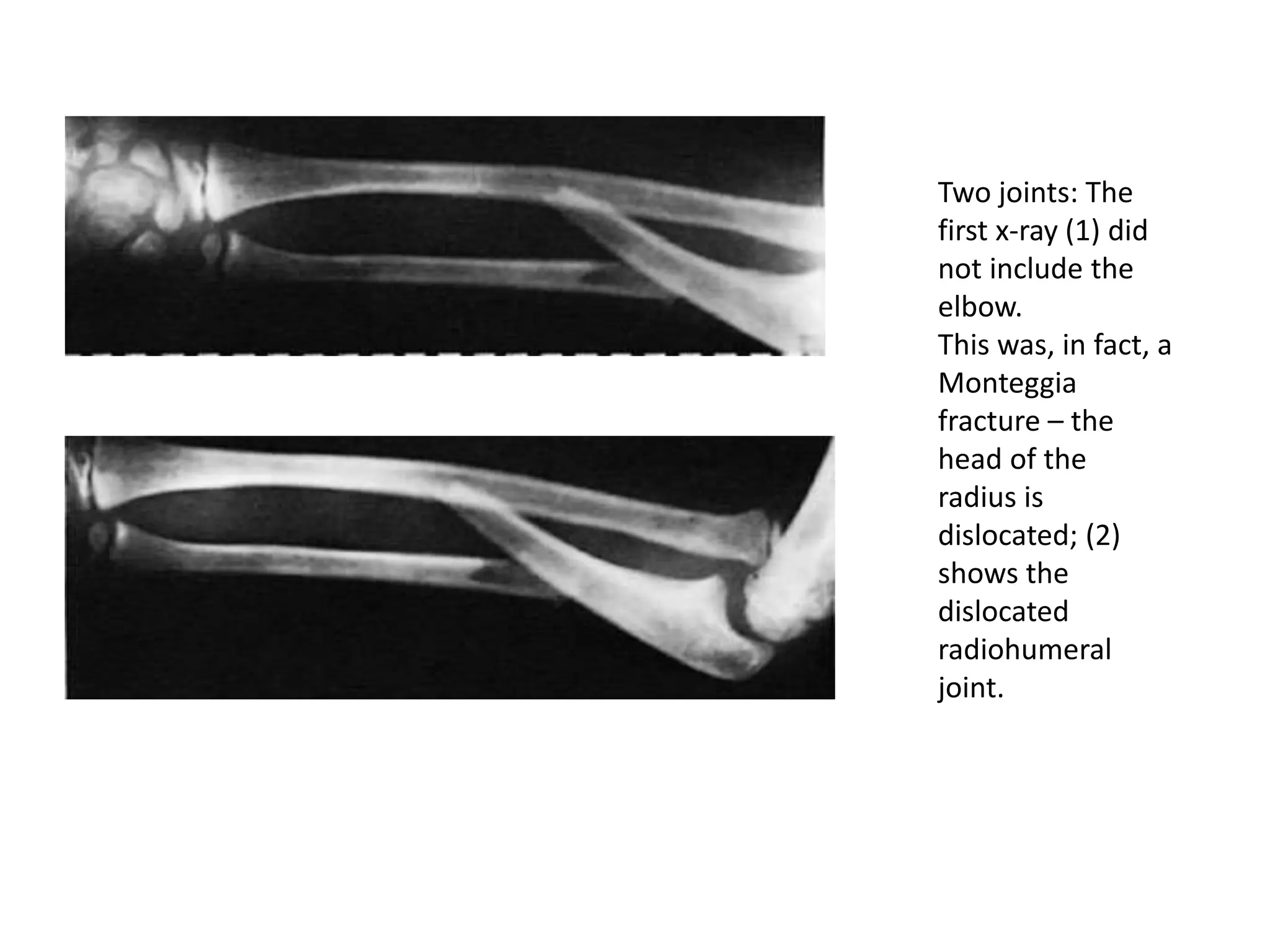 Two joints: The
first x-ray (1) did
not include the
elbow.
This was, in fact, a
Monteggia
fracture – the
head of the
radius is
dislocated; (2)
shows the
dislocated
radiohumeral
joint.
 
