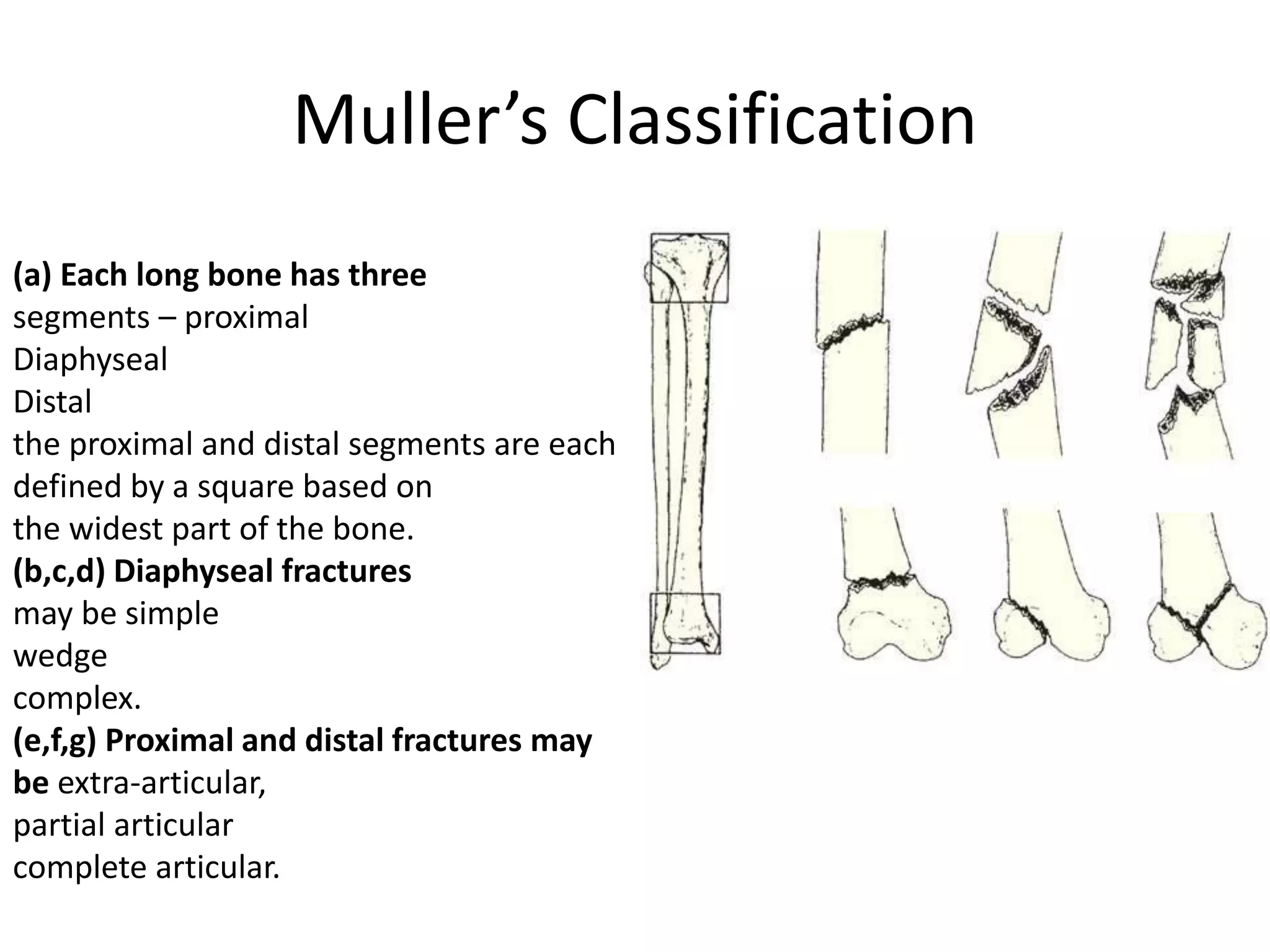 Muller’s Classification
(a) Each long bone has three
segments – proximal
Diaphyseal
Distal
the proximal and distal segments are each
defined by a square based on
the widest part of the bone.
(b,c,d) Diaphyseal fractures
may be simple
wedge
complex.
(e,f,g) Proximal and distal fractures may
be extra-articular,
partial articular
complete articular.
 