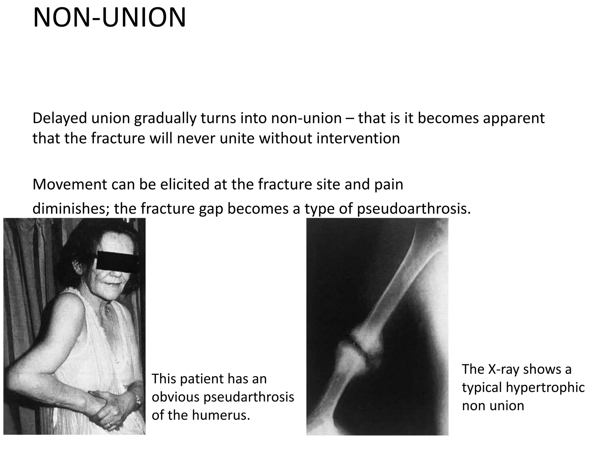 NON-UNION
Delayed union gradually turns into non-union – that is it becomes apparent
that the fracture will never unite without intervention
Movement can be elicited at the fracture site and pain
diminishes; the fracture gap becomes a type of pseudoarthrosis.
This patient has an
obvious pseudarthrosis
of the humerus.
The X-ray shows a
typical hypertrophic
non union
 