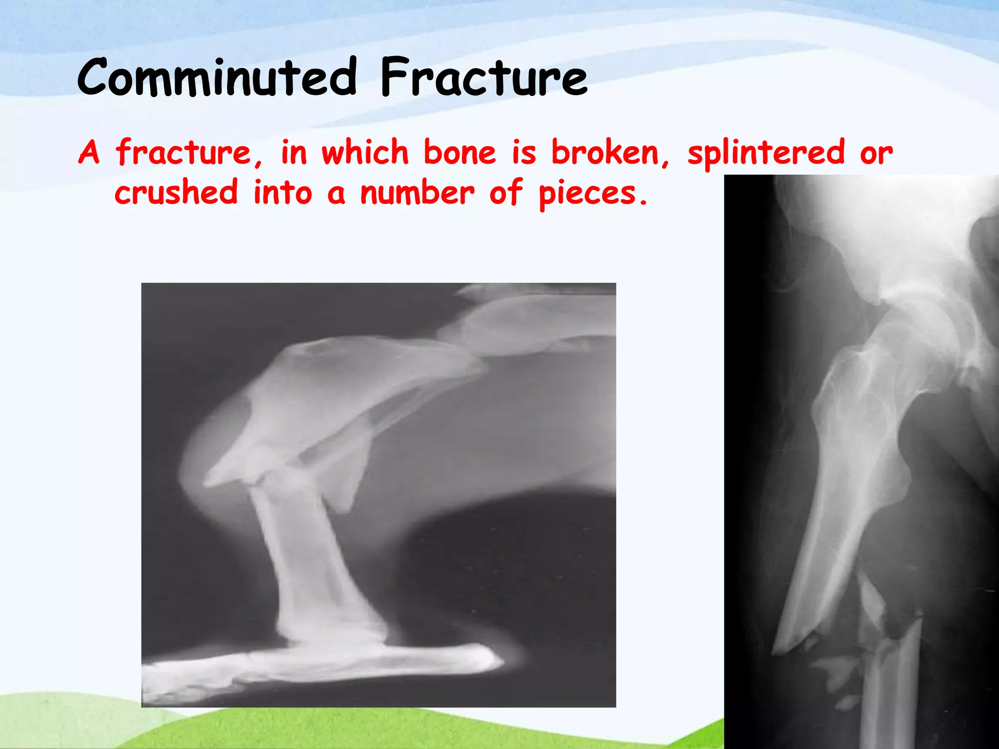 Fracture and its nursing management | PPTX