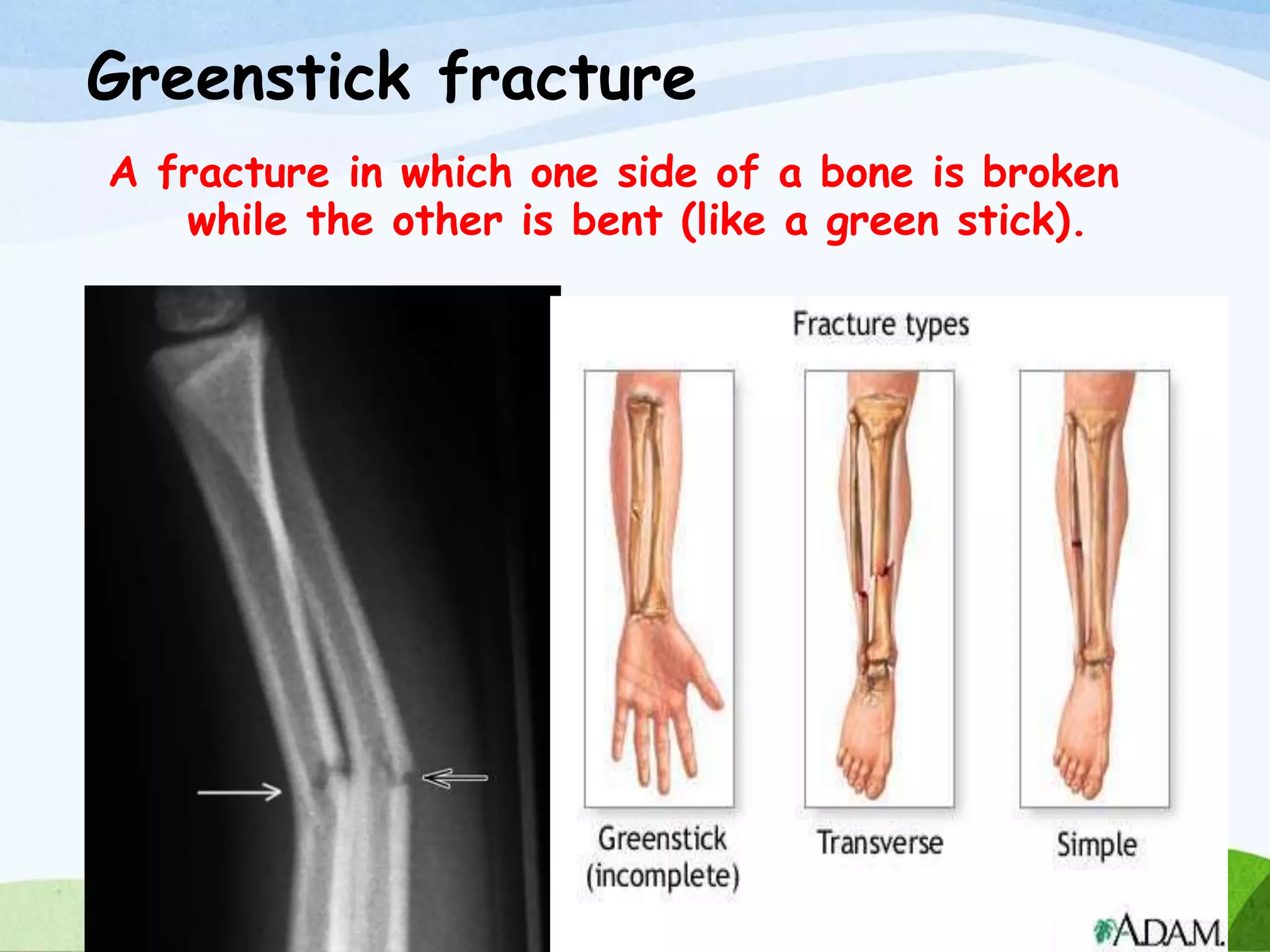 Fracture And Its Nursing Management PPTX