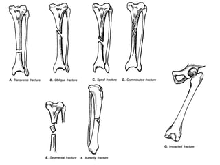 Fracture | PDF