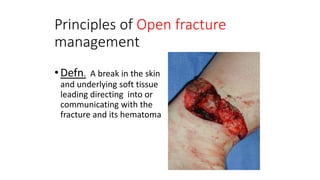 Principles of Open fracture
management
•Defn. A break in the skin
and underlying soft tissue
leading directing into or
communicating with the
fracture and its hematoma
 