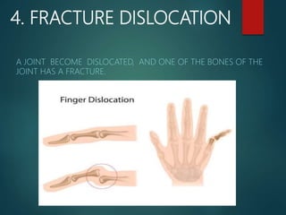Fracture | PPT