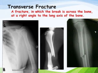 Transverse Fracture
A fracture, in which the break is across the bone,
at a right angle to the long axis of the bone.
 