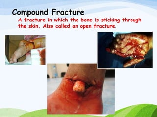 Compound Fracture
A fracture in which the bone is sticking through
the skin. Also called an open fracture.
 
