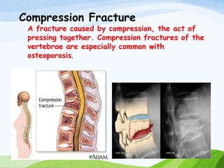 Compression Fracture
A fracture caused by compression, the act of
pressing together. Compression fractures of the
vertebrae are especially common with
osteoporosis.
 