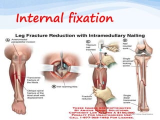 Internal fixation
 