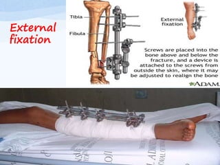 External
fixation
 