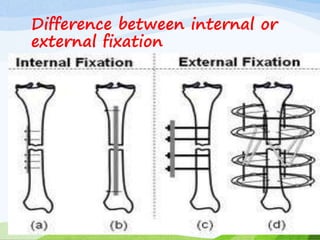 Difference between internal or
external fixation
 