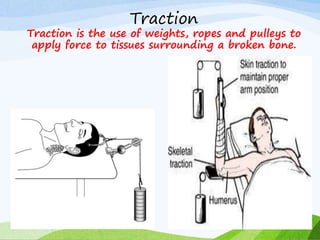 Traction
Traction is the use of weights, ropes and pulleys to
apply force to tissues surrounding a broken bone.
 