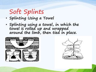 • Splinting Using a Towel
• Splinting using a towel, in which the
towel is rolled up and wrapped
around the limb, then tied in place.
Soft Splints
 