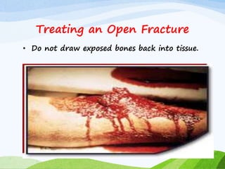 • Do not draw exposed bones back into tissue.
Treating an Open Fracture
 