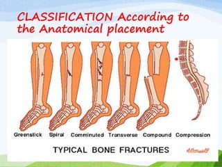 CLASSIFICATION According to
the Anatomical placement
 