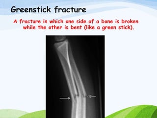 Greenstick fracture
A fracture in which one side of a bone is broken
while the other is bent (like a green stick).
 