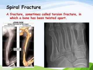 Spiral Fracture
A fracture, sometimes called torsion fracture, in
which a bone has been twisted apart.
 