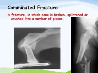 Comminuted Fracture
A fracture, in which bone is broken, splintered or
crushed into a number of pieces.
 