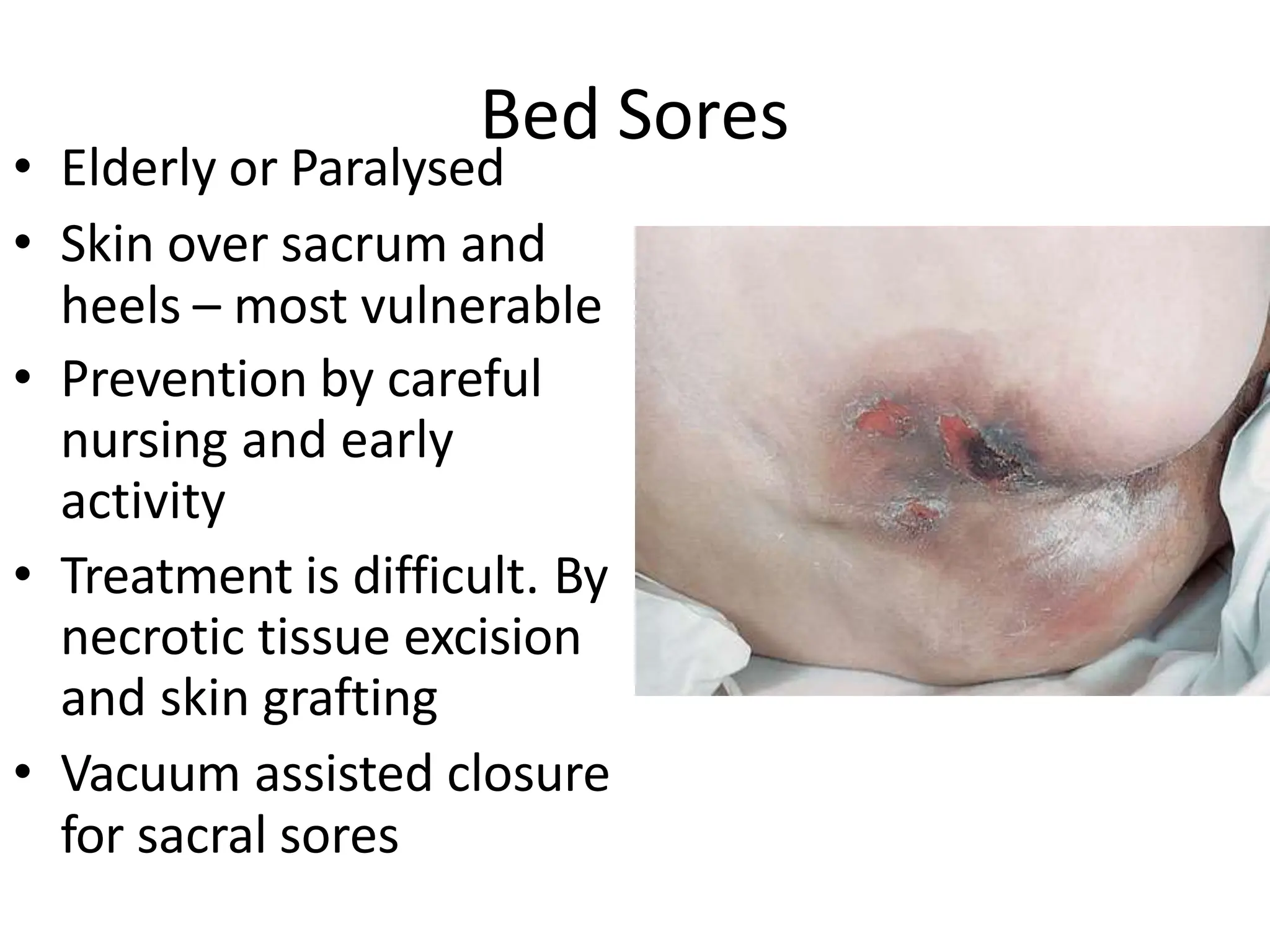 Bed Sores
• Elderly or Paralysed
• Skin over sacrum and
heels – most vulnerable
• Prevention by careful
nursing and early
activity
• Treatment is difficult. By
necrotic tissue excision
and skin grafting
• Vacuum assisted closure
for sacral sores
 