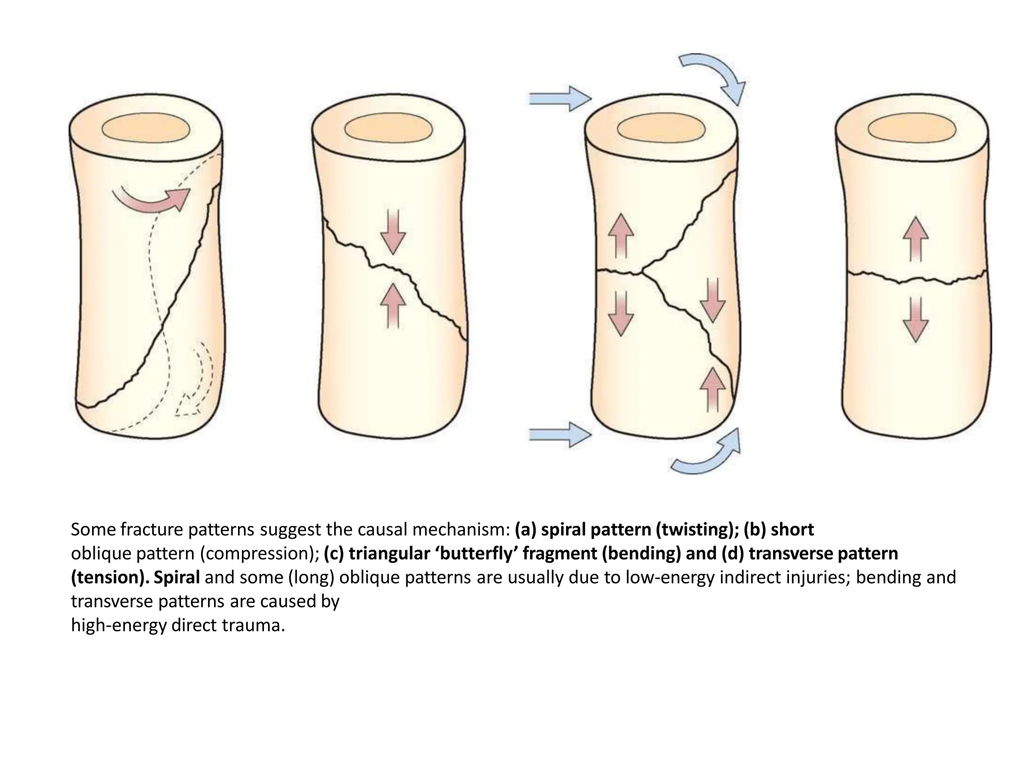 Some fracture patterns suggest the causal mechanism: (a) spiral pattern (twisting); (b) short
oblique pattern (compression); (c) triangular ‘butterfly’ fragment (bending) and (d) transverse pattern
(tension). Spiral and some (long) oblique patterns are usually due to low-energy indirect injuries; bending and
transverse patterns are caused by
high-energy direct trauma.
 