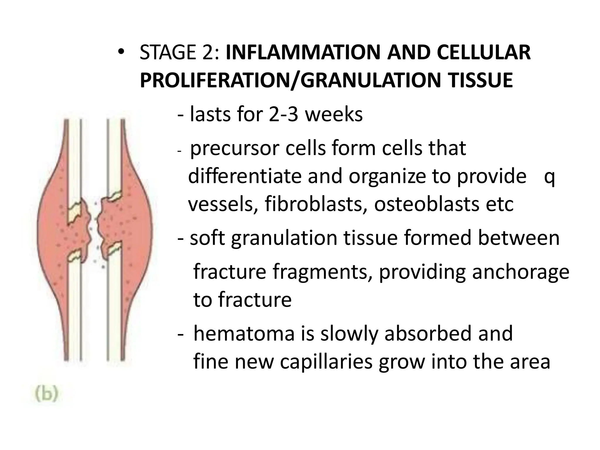 • STAGE 2: INFLAMMATION AND CELLULAR
PROLIFERATION/GRANULATION TISSUE
- lasts for 2-3 weeks
- precursor cells form cells that
differentiate and organize to provide q
vessels, fibroblasts, osteoblasts etc
- soft granulation tissue formed between
fracture fragments, providing anchorage
to fracture
- hematoma is slowly absorbed and
fine new capillaries grow into the area
 