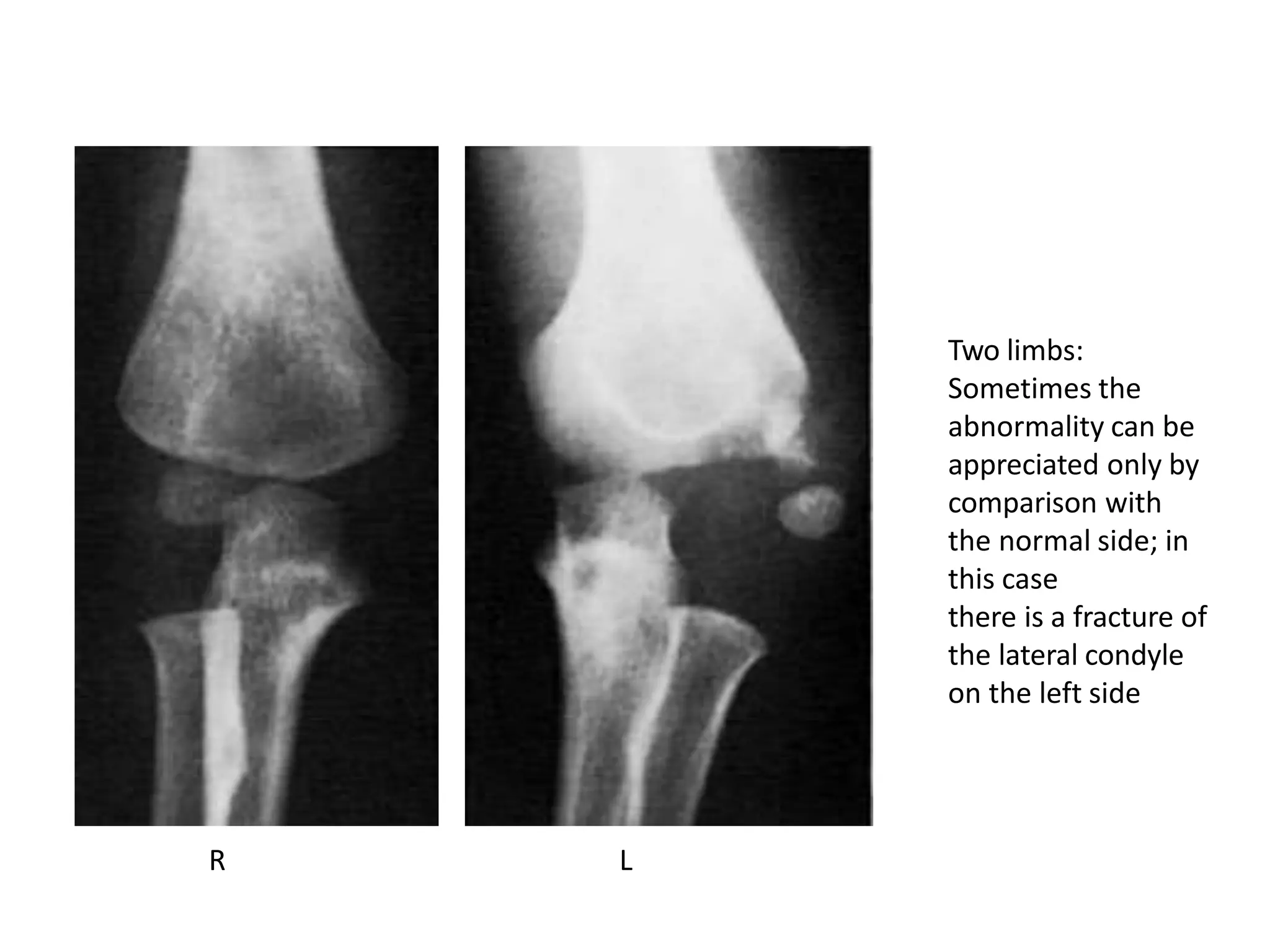 Two limbs:
Sometimes the
abnormality can be
appreciated only by
comparison with
the normal side; in
this case
there is a fracture of
the lateral condyle
on the left side
R L
 