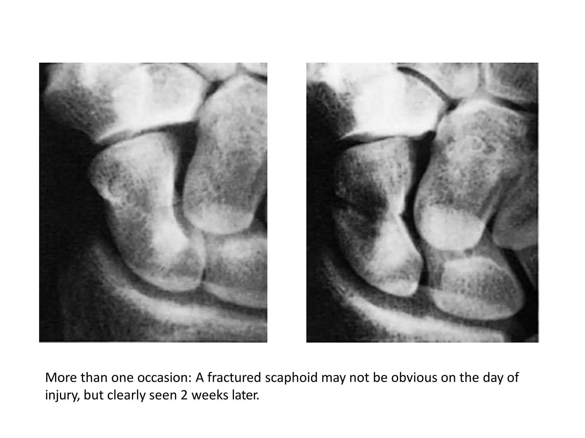 More than one occasion: A fractured scaphoid may not be obvious on the day of
injury, but clearly seen 2 weeks later.
 