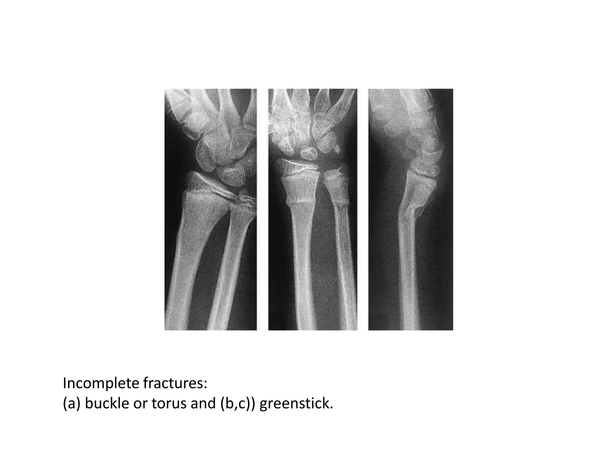 Incomplete fractures:
(a) buckle or torus and (b,c)) greenstick.
 