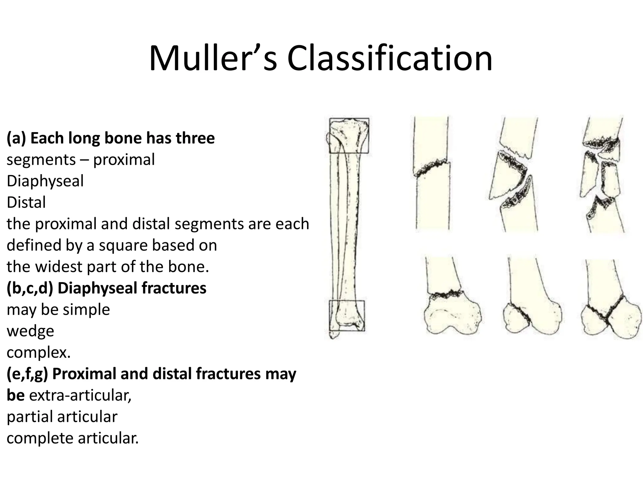 Muller’s Classification
(a) Each long bone has three
segments – proximal
Diaphyseal
Distal
the proximal and distal segments are each
defined by a square based on
the widest part of the bone.
(b,c,d) Diaphyseal fractures
may be simple
wedge
complex.
(e,f,g) Proximal and distal fractures may
be extra-articular,
partial articular
complete articular.
 