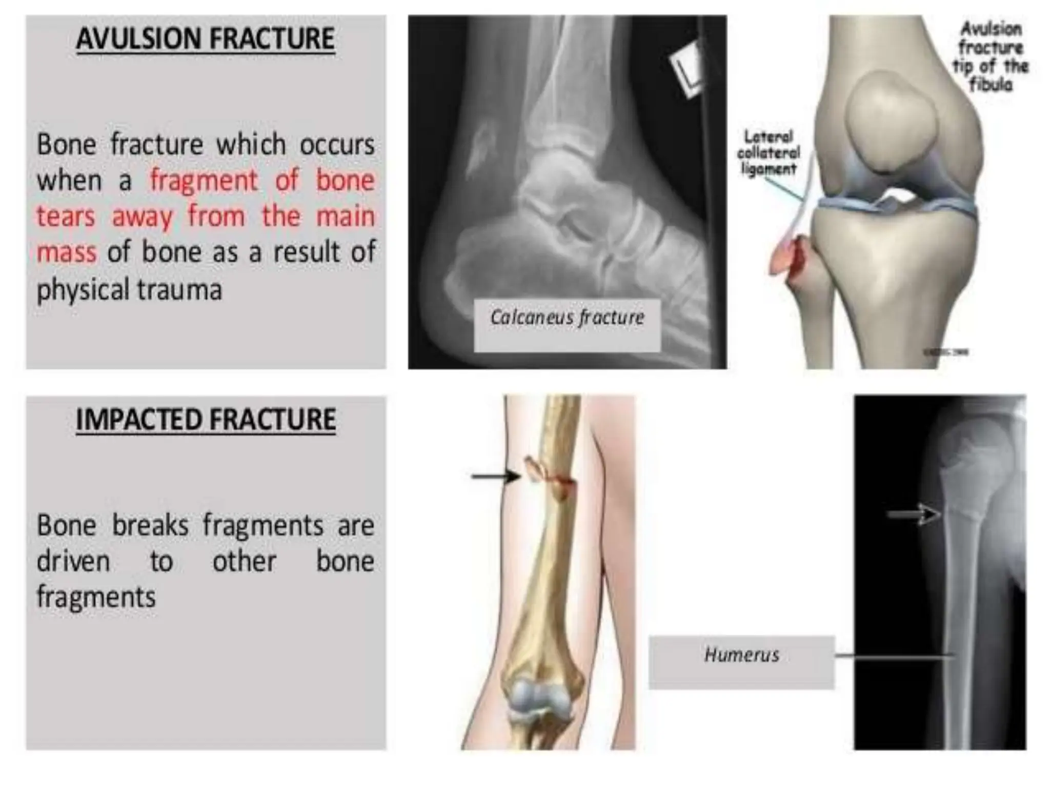 Fractures Base Math FRACTURE PPT (ORTHOPAEDIC) ALL BASIC INFORMATION | PPTX
