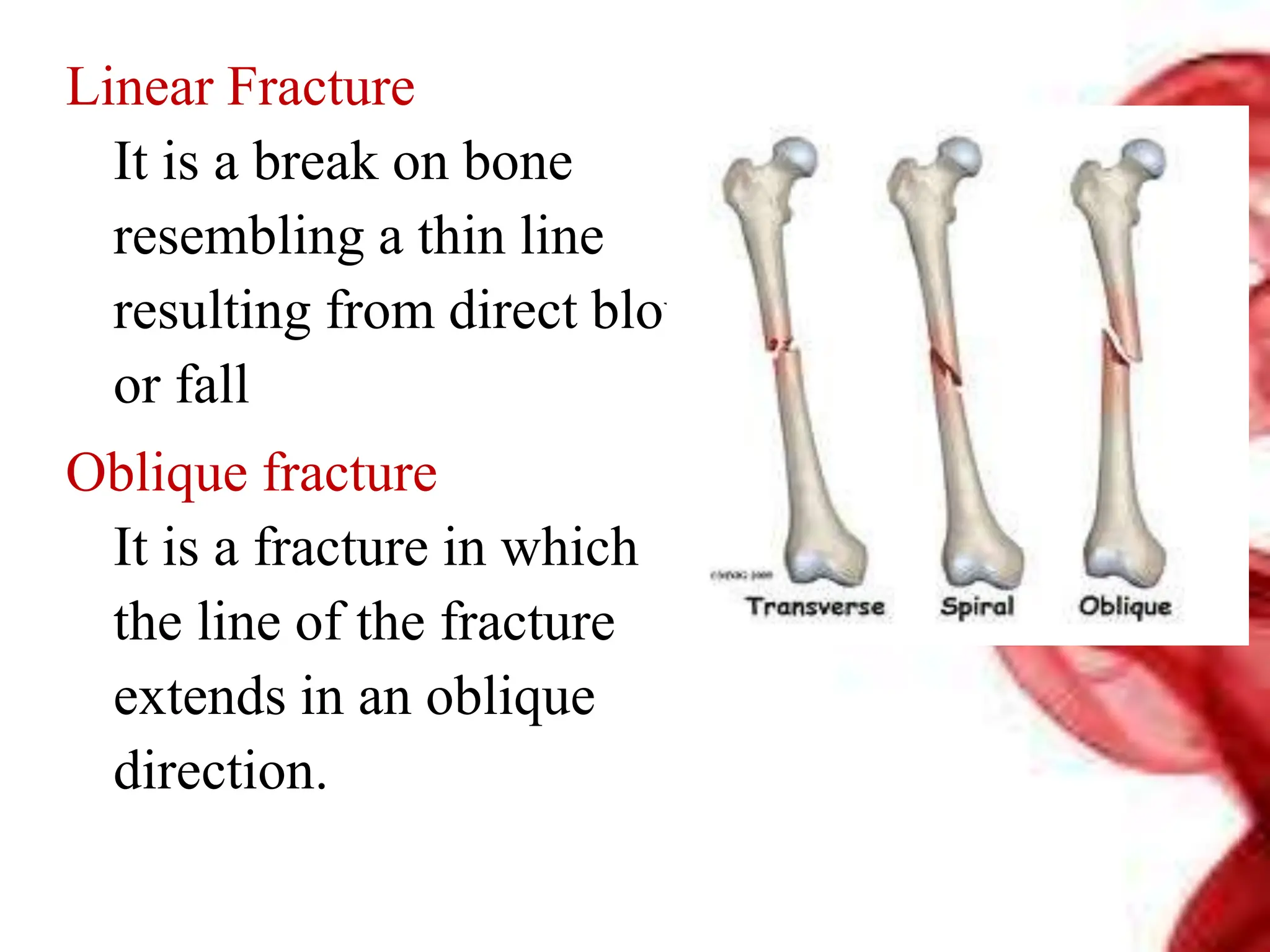 Linear Fracture
It is a break on bone
resembling a thin line
resulting from direct blow
or fall
Oblique fracture
It is a fracture in which
the line of the fracture
extends in an oblique
direction.
 