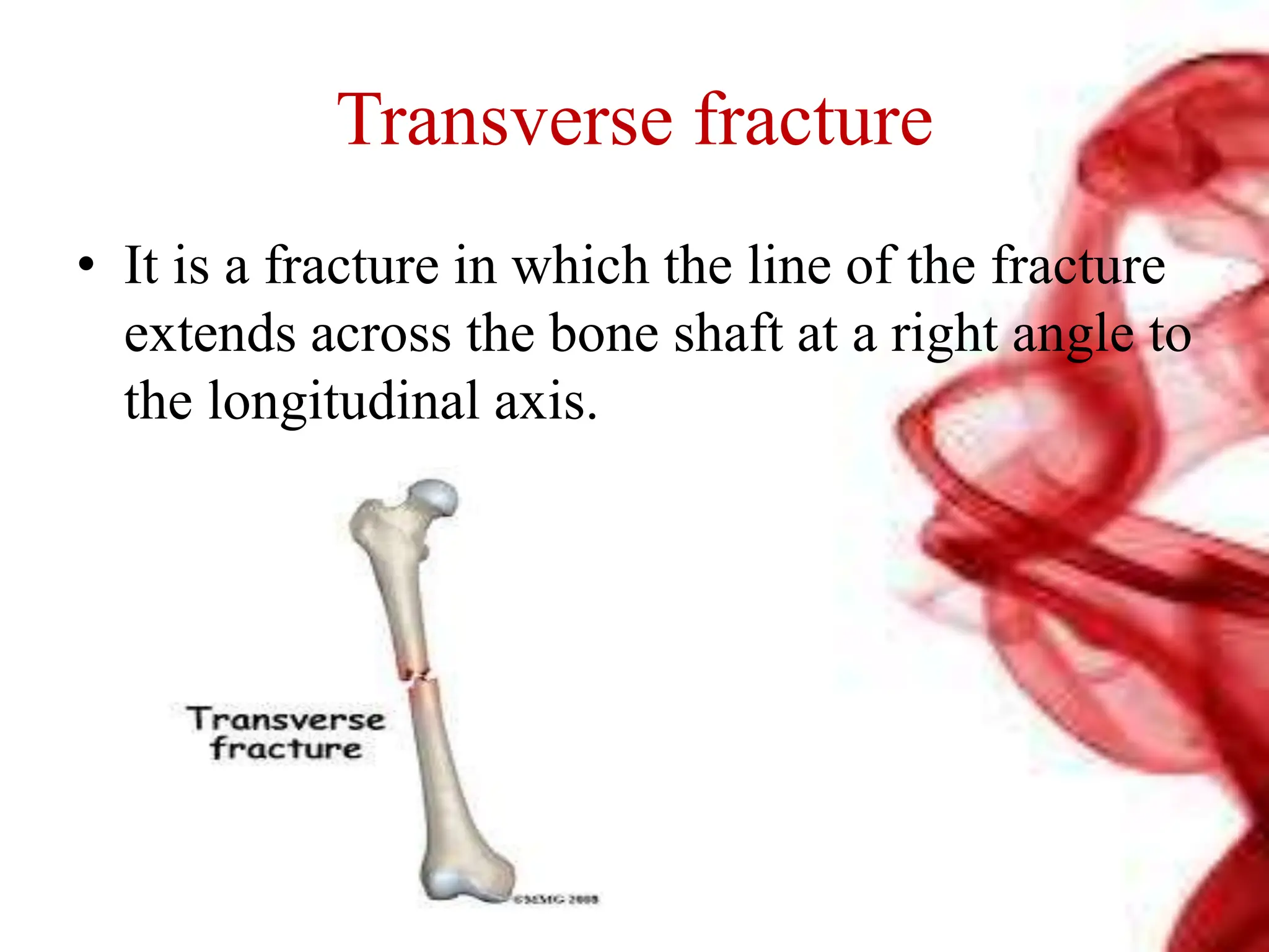 Transverse fracture
• It is a fracture in which the line of the fracture
extends across the bone shaft at a right angle to
the longitudinal axis.
 