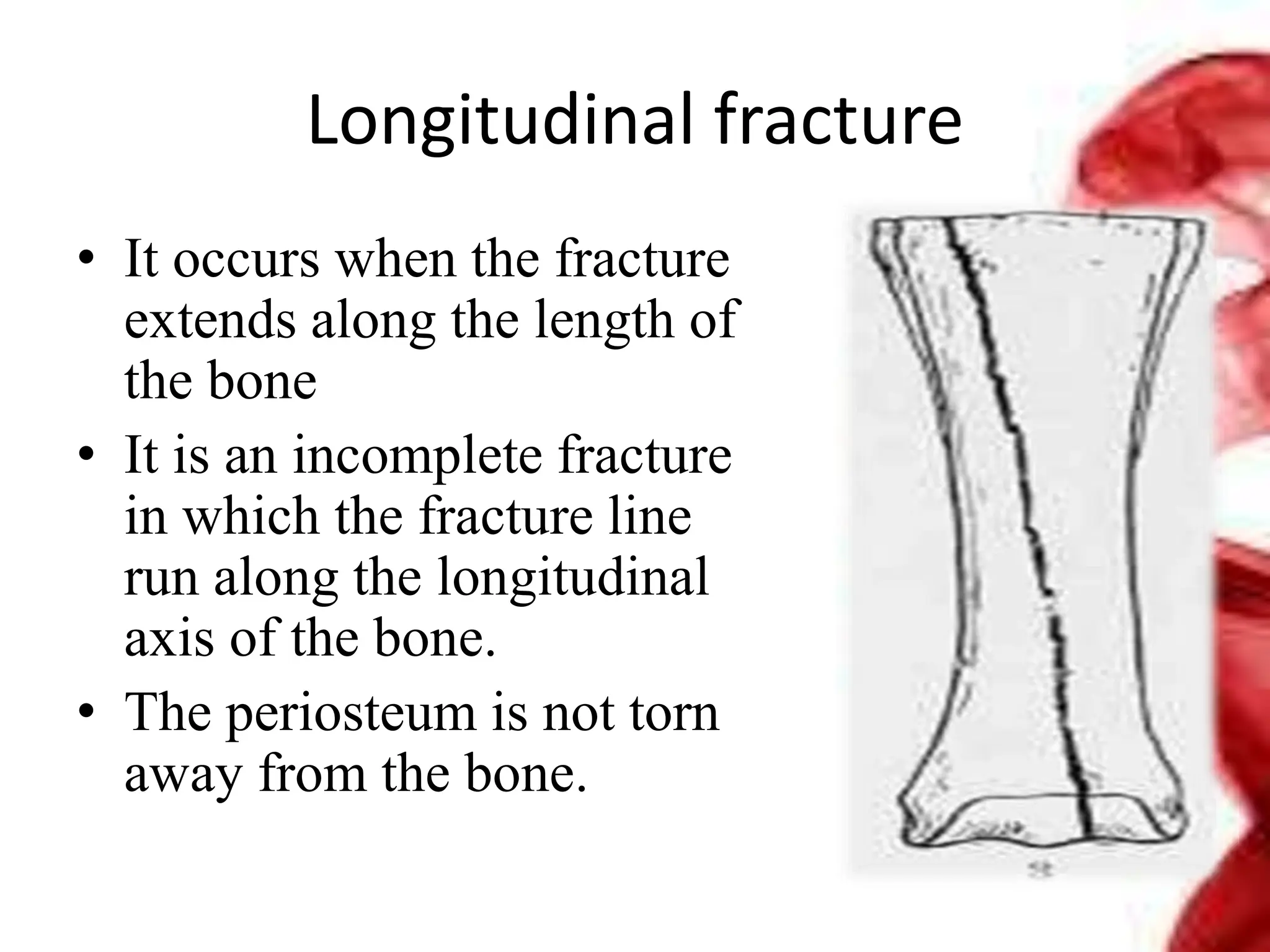 Longitudinal fracture
• It occurs when the fracture
extends along the length of
the bone
• It is an incomplete fracture
in which the fracture line
run along the longitudinal
axis of the bone.
• The periosteum is not torn
away from the bone.
 