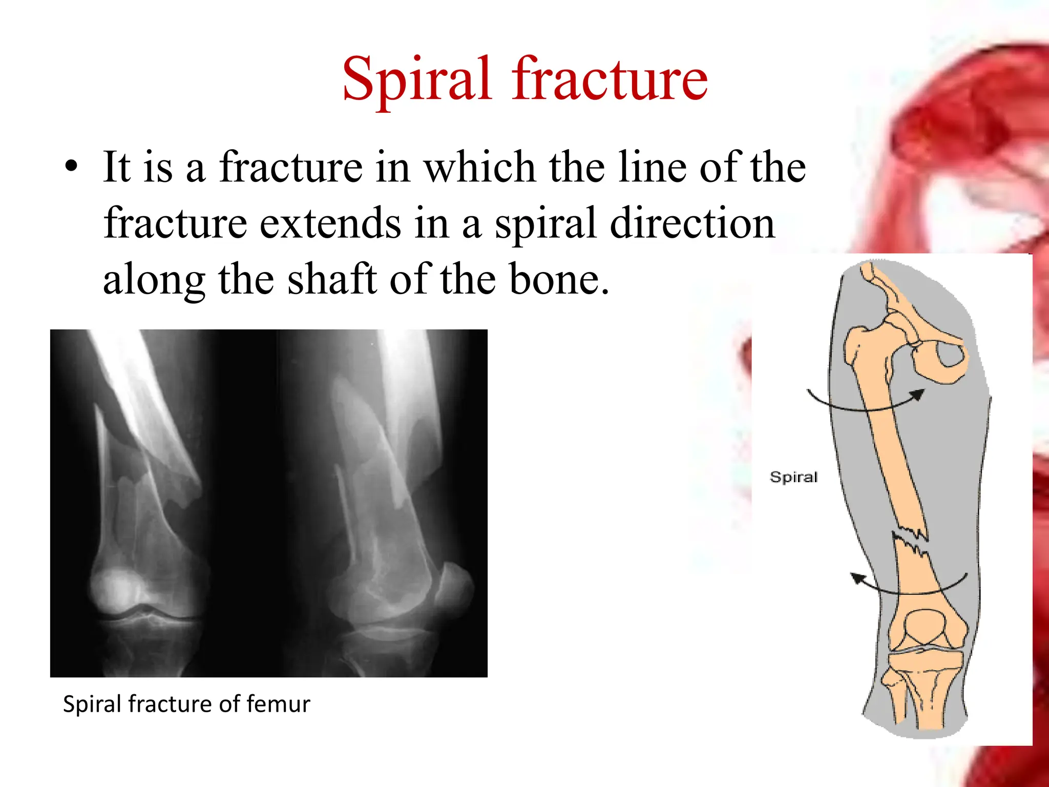 Spiral fracture
• It is a fracture in which the line of the
fracture extends in a spiral direction
along the shaft of the bone.
Spiral fracture of femur
 