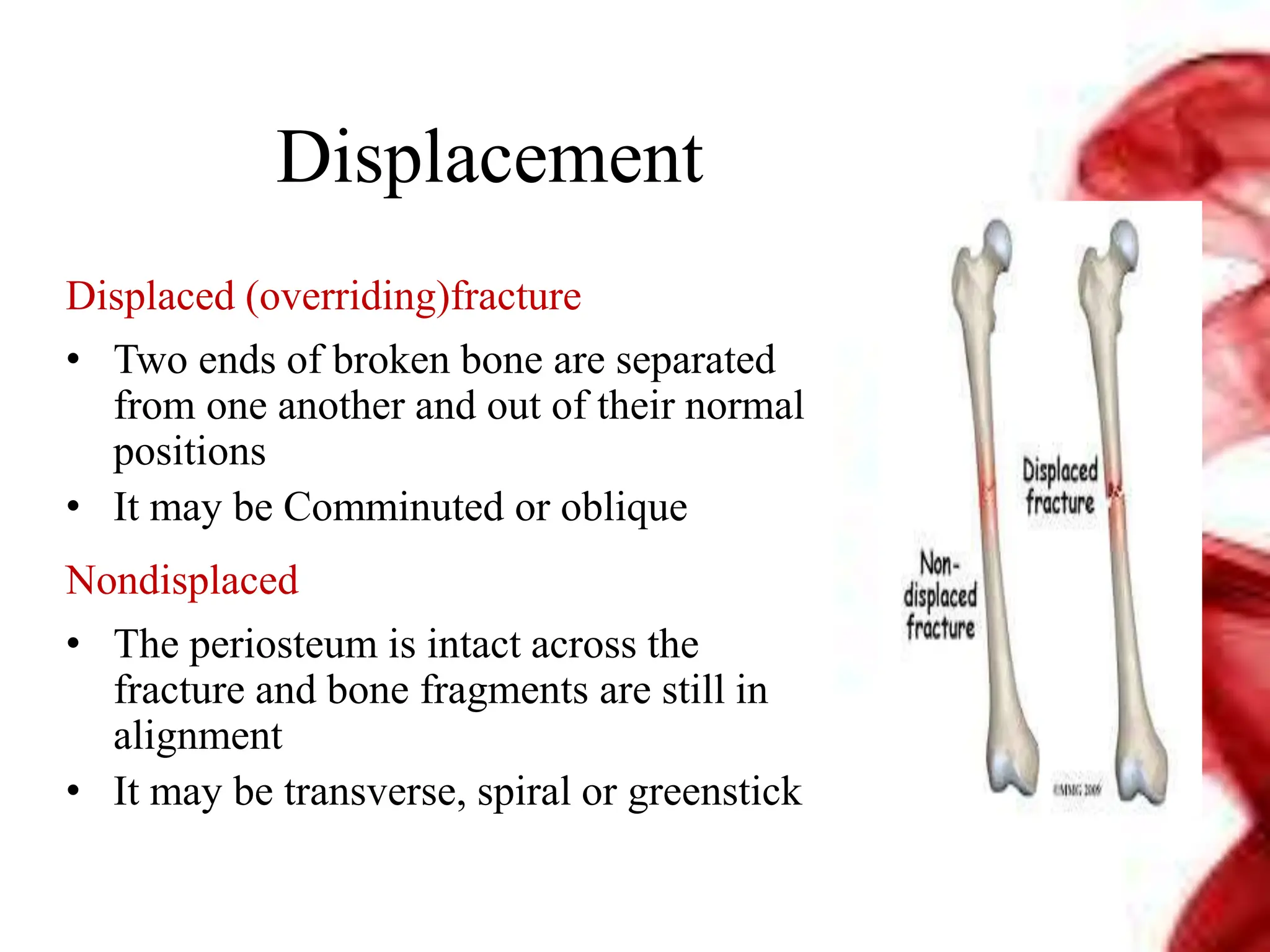 Displaced (overriding)fracture
• Two ends of broken bone are separated
from one another and out of their normal
positions
• It may be Comminuted or oblique
Nondisplaced
• The periosteum is intact across the
fracture and bone fragments are still in
alignment
• It may be transverse, spiral or greenstick
Displacement
 