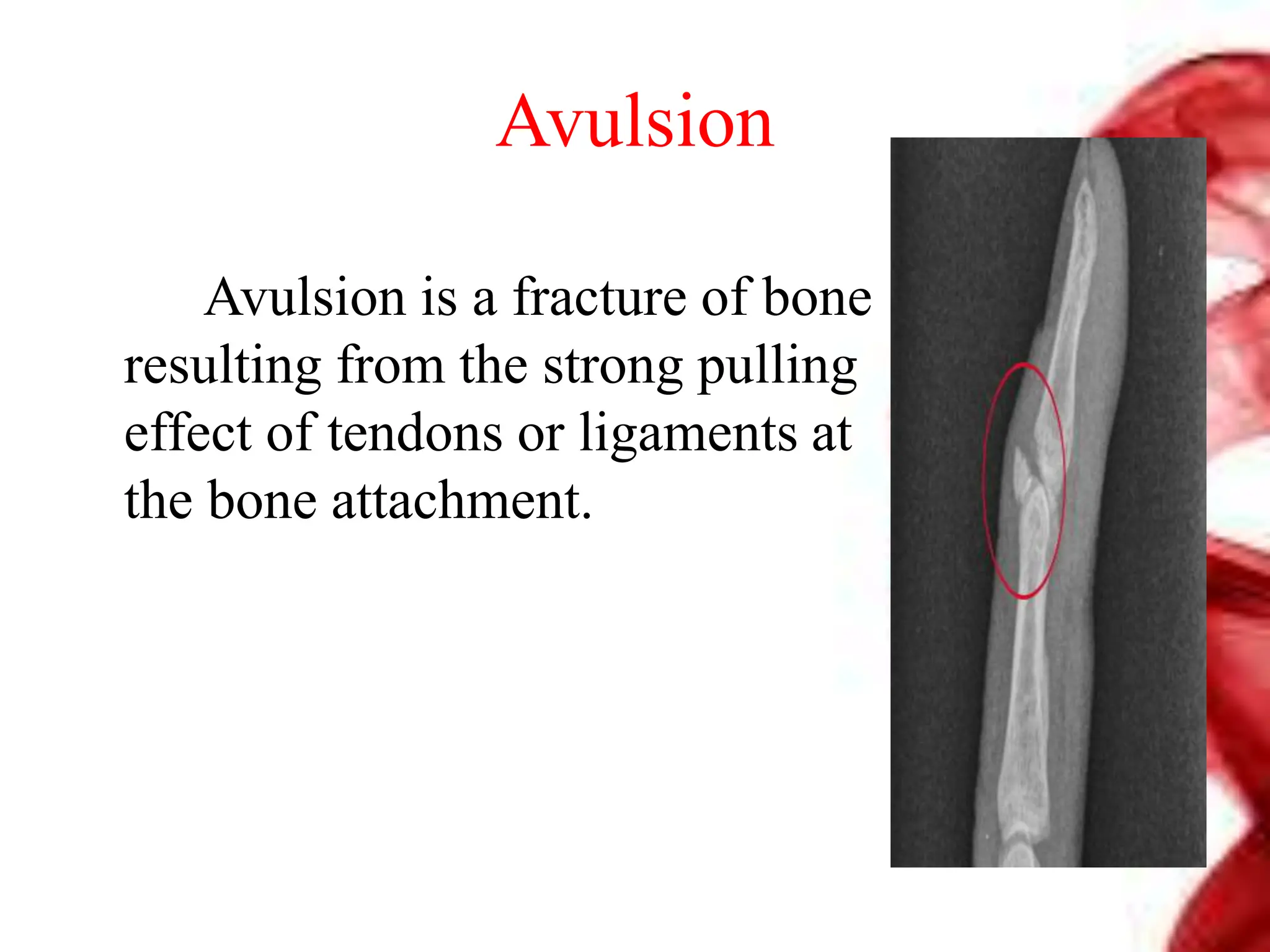 Avulsion
Avulsion is a fracture of bone
resulting from the strong pulling
effect of tendons or ligaments at
the bone attachment.
 